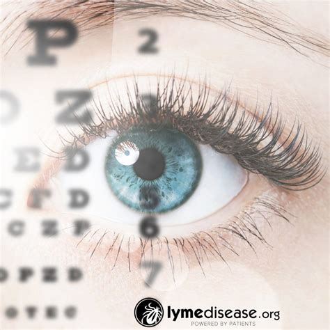 5 Signs That Your Eyes Have Visual Contrast Sensitivity