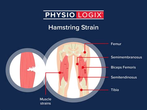 5 Simple Steps to Help Recover from a Pulled Hamstring Fleming Medical
