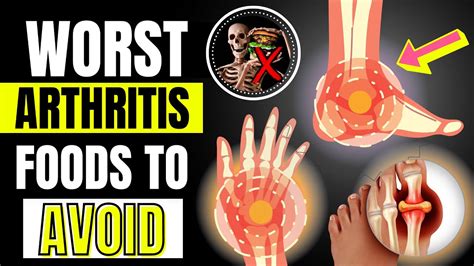 5 Worst Foods For Arthritis & Joint Pain