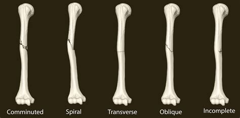 5.5: Fractures - Bone Repair - Medicine LibreTexts