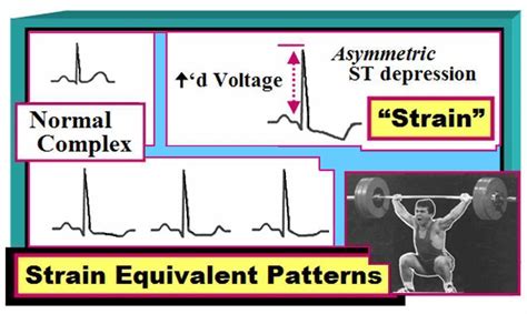 51 EKG & Arrthymias ideas nursing study, nursing notes