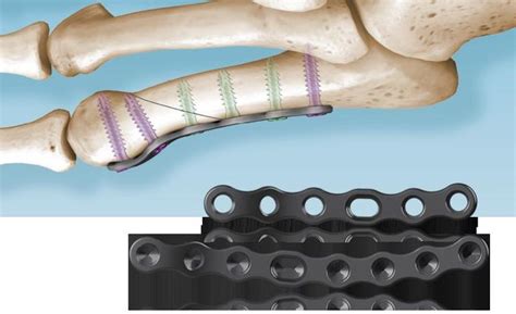 5MS Fracture System – In2Bones - i2b-usa.com