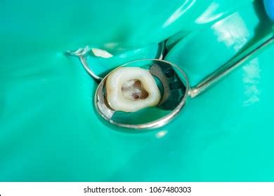 6,281 Root canal treatment Images, Stock Photos & Vectors - Shutterst…