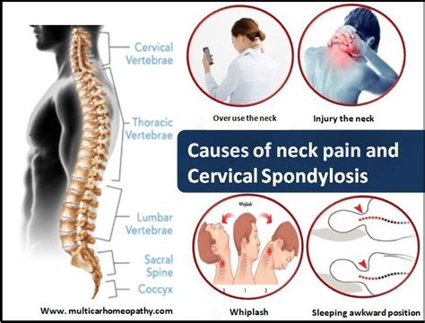 6 Best Homeopathic Medicines for Cervical spondylitis …