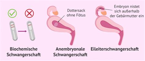 6 ssw anzeichen fehlgeburt