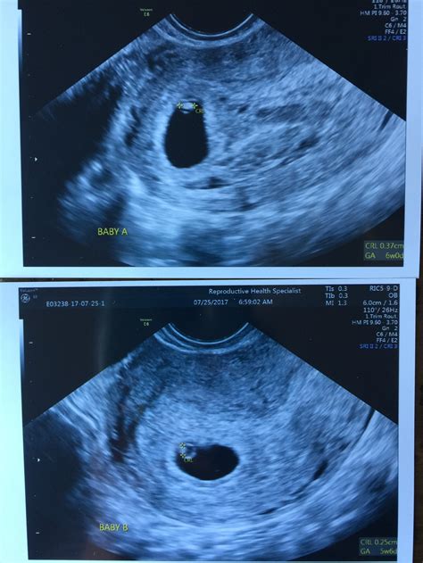 6 week ultrasound no heartbeat. In a world where we count every step and measure every heartbeat, hopping on the scale once per week to keep half an eye on what your body is doing just won’t do. Even if you stand... 