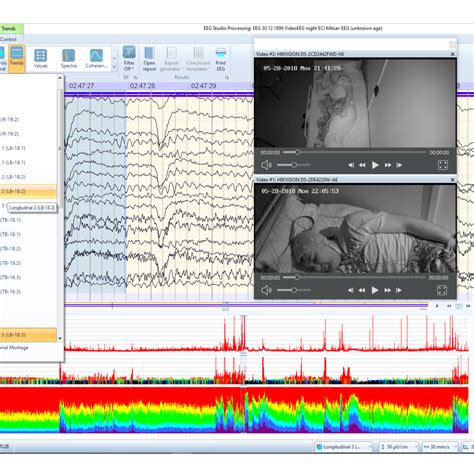 64-Channel System for Long-Term Video EEG Monitoring