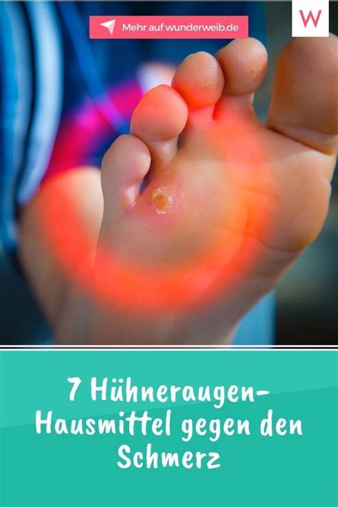 7 Hühneraugen-Hausmittel gegen den Schmerz Wunderweib