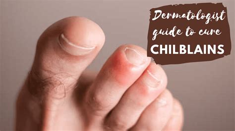 8 Natural Remedies for Chilblains that really work I