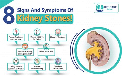 8 signs of kidney stones HealthShots