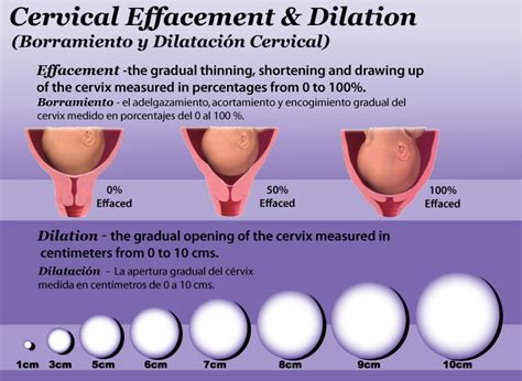 The first stage of labor ends when a woman’s cervix is fully dilated to 10 cm and fully effaced (thinned out). Stage 2 of labor The second stage of labor begins when a woman’s cervix is fully ...