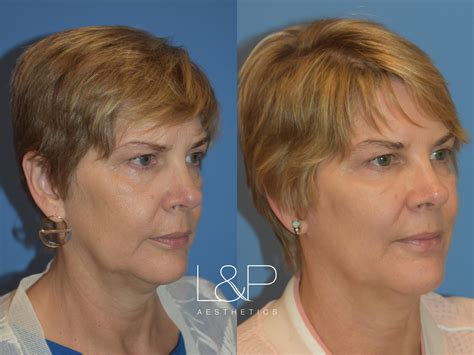 9 Facial Fillers Chillicothe Providers Facial Fillers - AHB