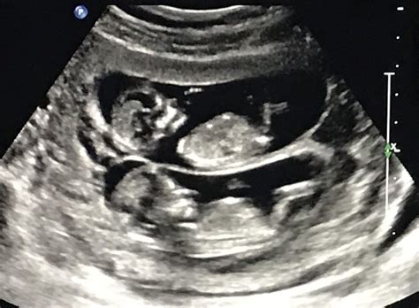 9 week to 13 week ultrasound - October 2024 Babies Forums