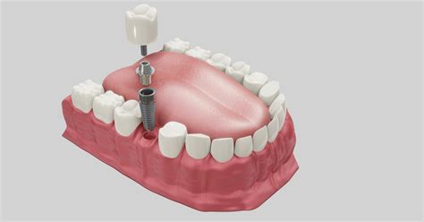 Ağız ve diş sağlığı merkezlerinde implant yapılıyor mu