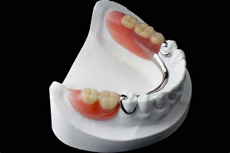 A 20clinical 20evaluation 20of 20fixed 20partial 20denture 20impressions