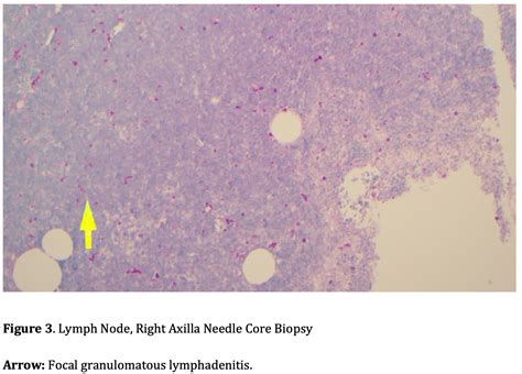 A Case of Chronic Granulomatous Mastitis Caused by …