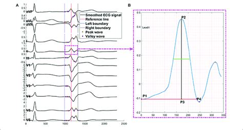 A Comparative Approach to ECG Feature Extraction Methods
