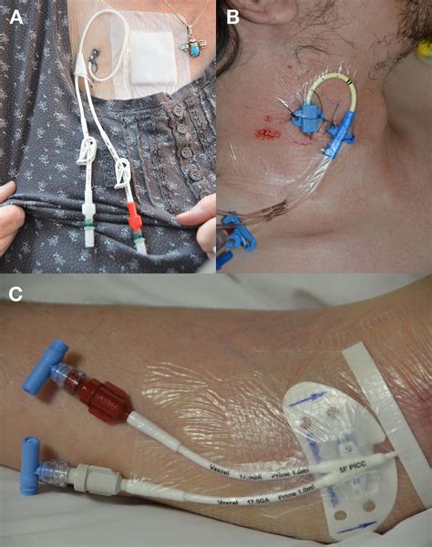 A Complicated Case of Central Venous Cannulation