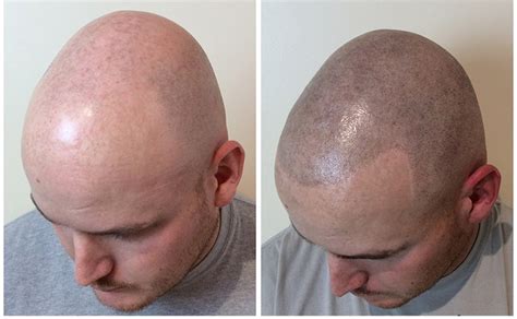 A Dive Into Male Pattern Baldness Among Gay Men
