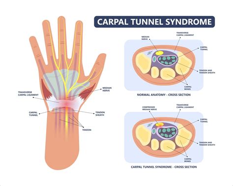 A Law for Carpal Tunnel Syndrome Disability