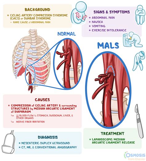 A Ligamentous Agony: Median Arcuate Ligament Syndrome as an …