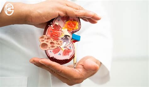 A N A GE UnderstandingM Chronic Kidney Disease