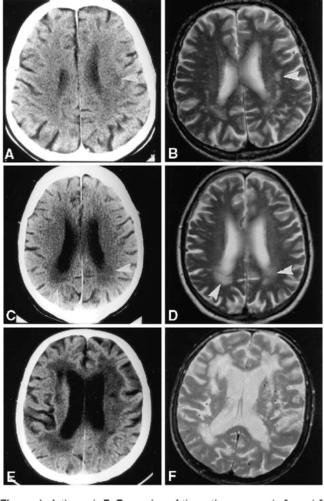 A New Rating Scale for Age-Related White Matter Changes …