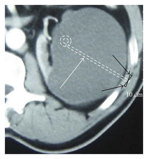 A New Technique for Simple Renal Cyst: Cystoretroperitoneal Shunt …