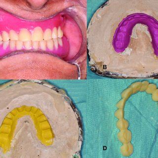 A Novel Method of Reinforcing Acrylic Denture A Case Report