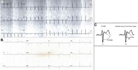A Practical Approach to the Investigation of an rSr’ Pattern in Leads