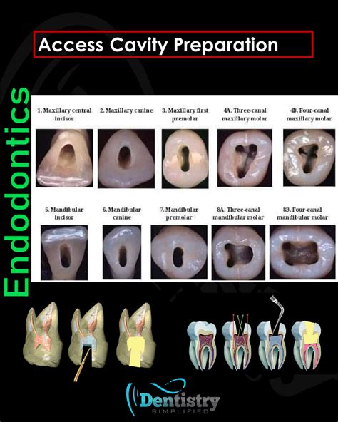 A Practical Guide to Endodontic Access Cavity Prep