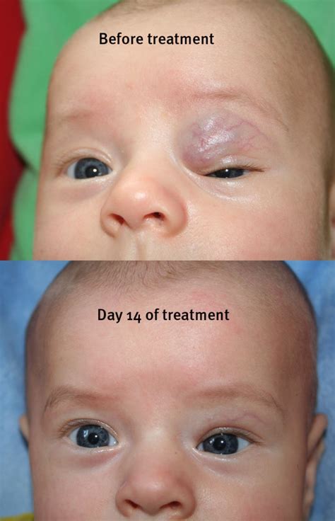 A RCT of Oral Propranolol in Infantile Hemangioma