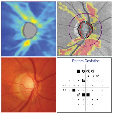 A Review on the Video Summarization and Glaucoma Detection