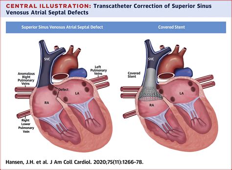 A Simplified Method for Treating Septal Defects