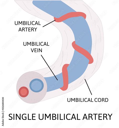 A Single Umbilical Artery