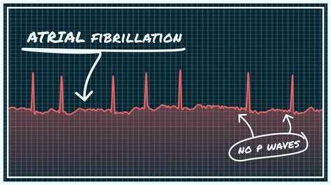 A Trial Fibrillation