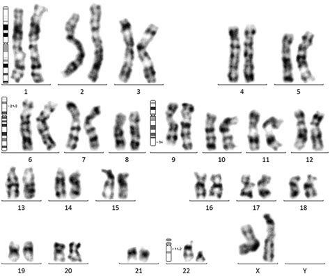 A Unique Three-Way Variant Philadelphia Chromosome t(6;9;22…