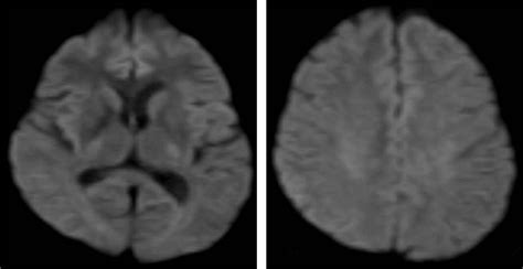 A case of hypoxic encephalopathy induced by the inhalation …