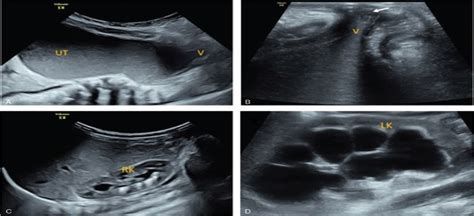 A case report of hydronephrosis caused by imperforate hymen ... - LWW