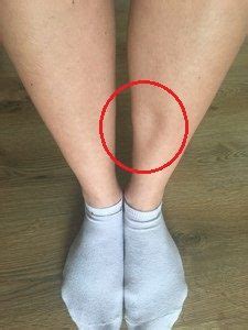 A dent in my leg. This approach, too, is appropriate for swollen legs from injury. While hot water can fix the swollen legs, cold compression can also give relief. Just take an ice-bag full of ice and gently keep it pressed against the leg muscles or shin. Hold the ice bag in this position for about 20-30 minutes, readjusting the position every now and then. 