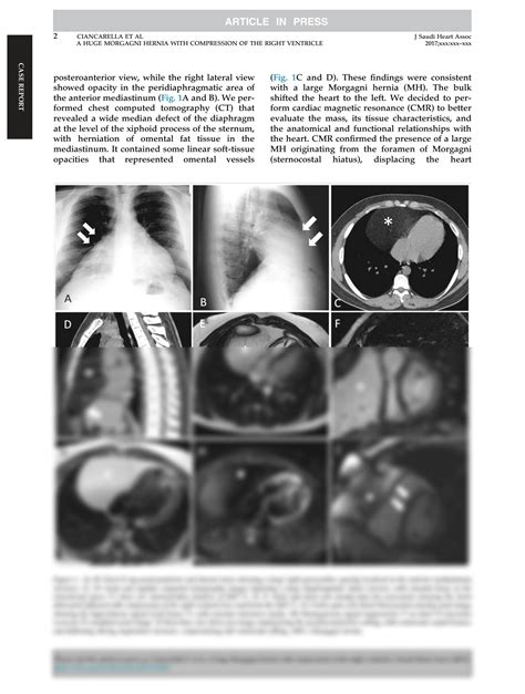 A huge Morgagni hernia with compression of the right ventricle