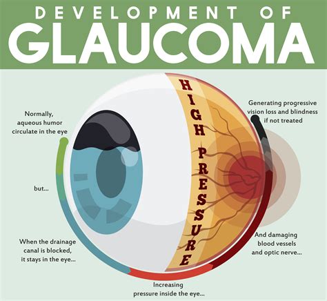 A patient s guide to glaucoma and glaucoma treatment a patient s guide to glaucoma and glaucoma treatment. - 365kb the man s mind a pocket guide for women.