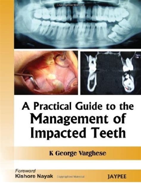 A practical guide to the management of impacted teeth 1st edition. - Parto sacro santo a la dei para siempre virgen maria.