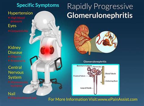 A simple guide to glomerulonephritis diagnosis treatment and related conditions. - Folle équipée de la duchesse de berry.