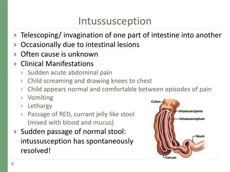 A simple guide to intussusception treatment and related diseases a. - Case ih mx 135 tractor manual gratis.