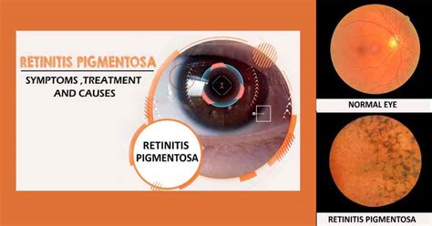 A simple guide to retinitis pigmentosa diagnosis treatment and related conditions a simple guide to medical conditions. - Manuale della gru a torre potain 85.