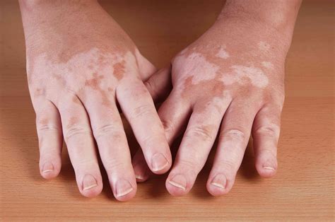 A simple guide to vitiligo and pigmentation of the skin. - Taste of the town a guided tour of college footballs best places to eat.