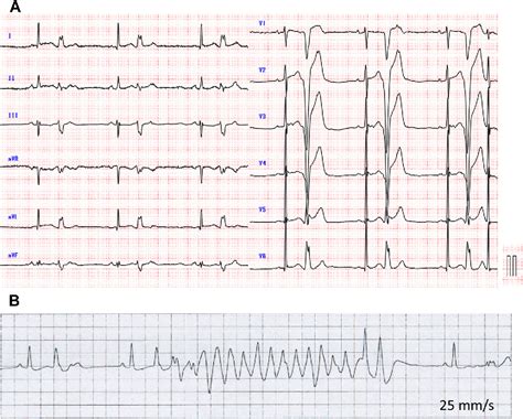 A subtype of idiopathic ventricular fibrillation and its relevance to ...