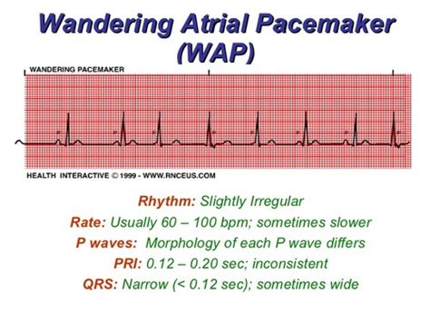  Wandering Atrial Pacemaker Rhythm: Regular or irregular Rate:Usually normal (60 to 100 beats/minute) but may be slow (less than 60 beats/minute) P waves:Vary in size, shape, and direction across rhythm strip; one P wave precedes each QRS complex PR interval:Usually normal duration, but may be abnormal depending on changing pacemaker location ... . 