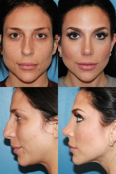 A1 Rhinoplasty Cosmetic Nose Surgery